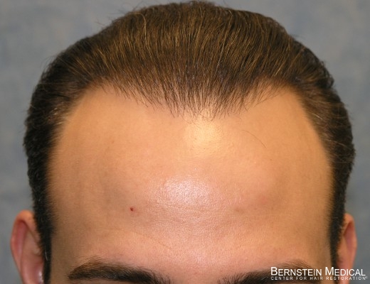 best way to regrow hair loss